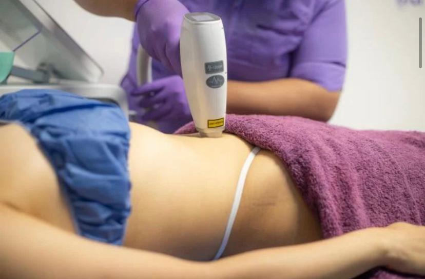 Depilación Láser con Diodo de Triple Onda